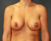 Feel Beautiful - Breast Enhancement San Diego 85 - After Photo